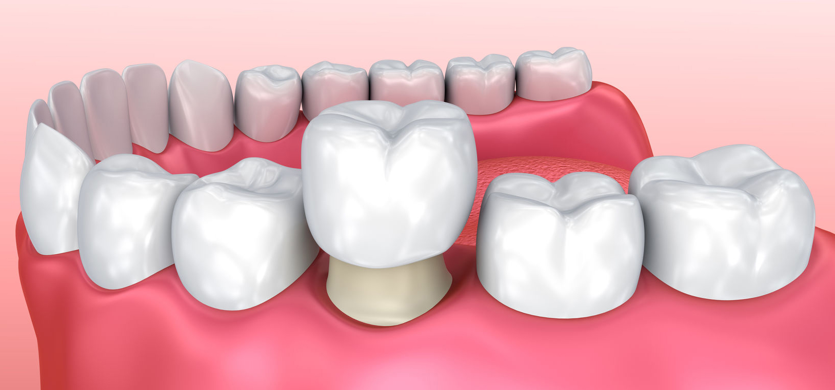 Dental Crown