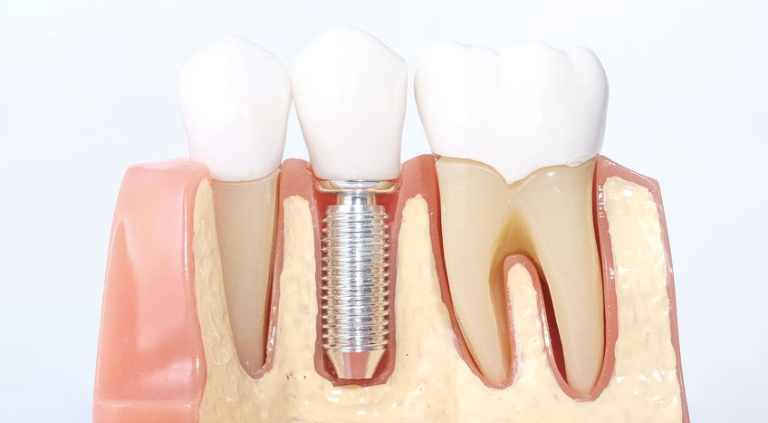 Dental Implant Illustration