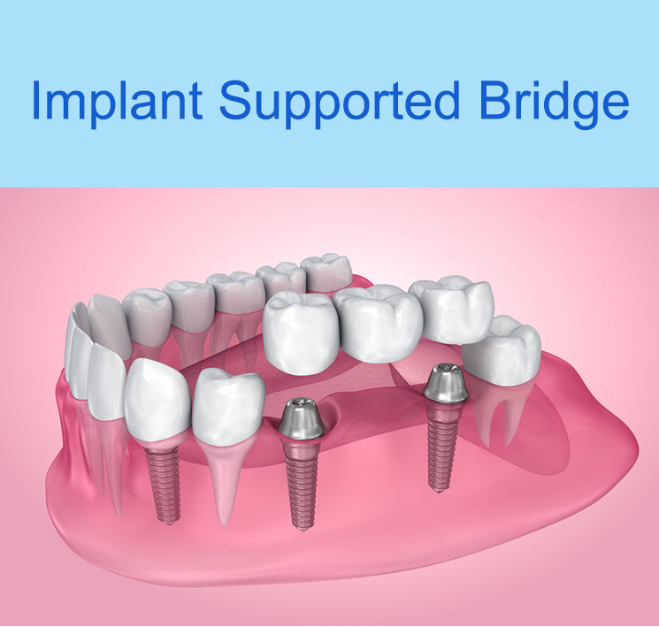 Implant Supported Bridge