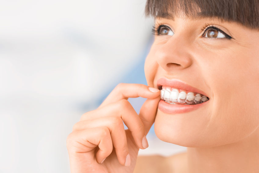 Invisalign system Invisalign system