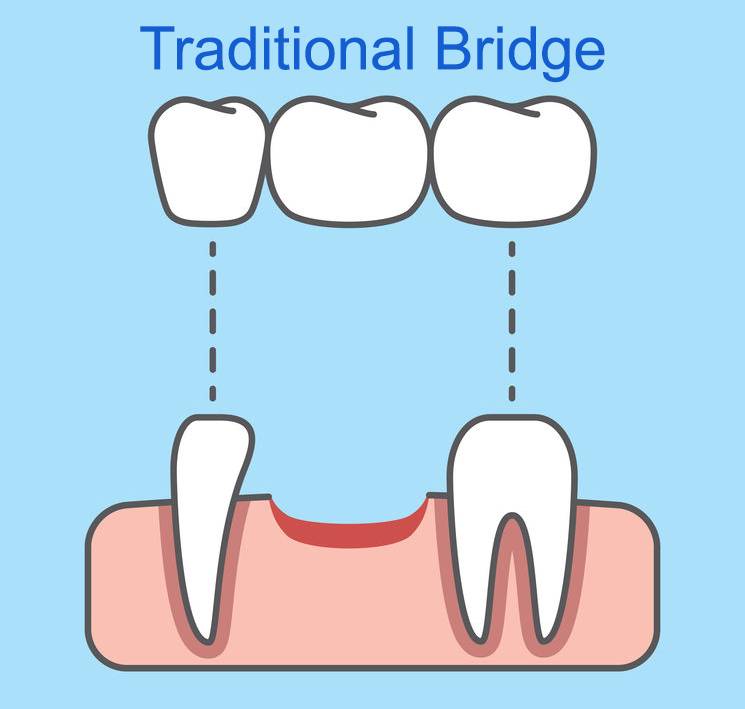 Traditional Bridge